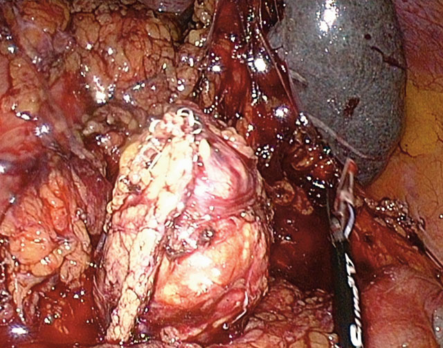 Bilde 3. Her er pancreas delt med ENDO GIA grønt magasin.